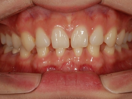 [ 학동역 교정치과 미소가아름다운치과 ] 부분교정 관련 이미지 2