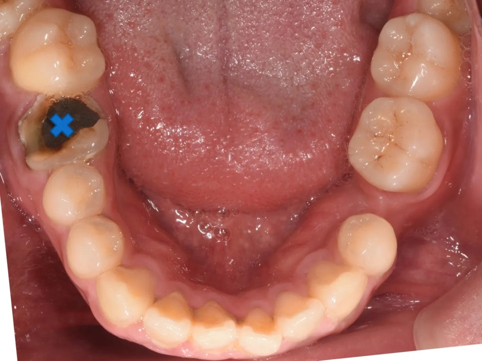 돌출입 교정 전후, 그런데 과개교합까지 있으셨던 환자분 관련 이미지 10