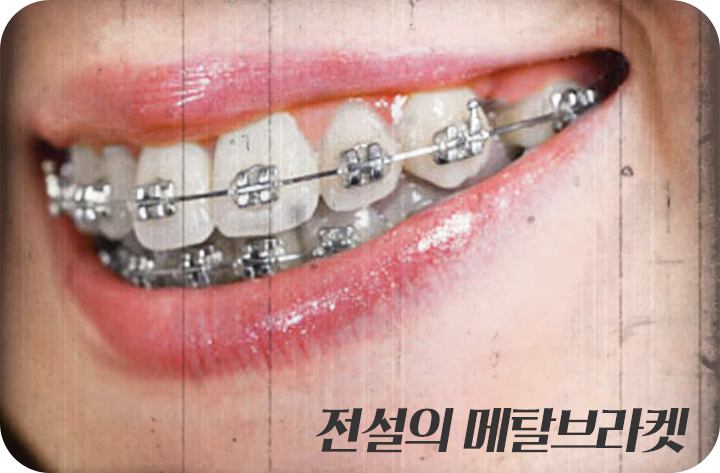 강남치아교정 브라켓비교분석 관련 이미지 2