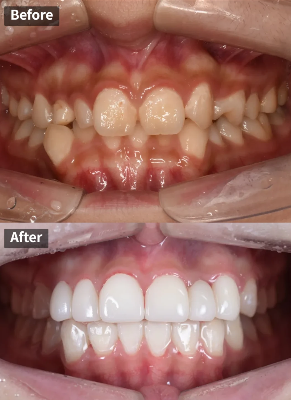 왜소치, 결손치가 동시에 있었던 환자의 앞니 심미보철 관련 이미지 1