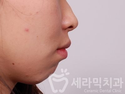 무턱교정, 거미스마일 교정 잘하는 학동역 세라믹치과 관련 이미지 3