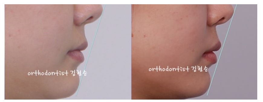 세라믹교정 은 "세라믹 치과 " 관련 이미지 7