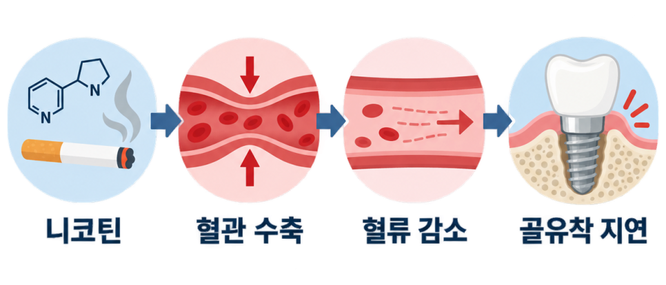 흡연자라면 강남구청 치과 상담 전에 알아둘 임플란트 실패 위험 이야기 관련 이미지 3
