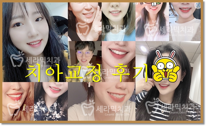 벌어진치아, 앞니벌어짐 치아교정전후 관련 이미지 6