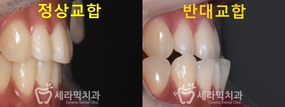 세라믹치과 치아교정전후 : 앞니반대교합+치열불규칙 관련 이미지 1