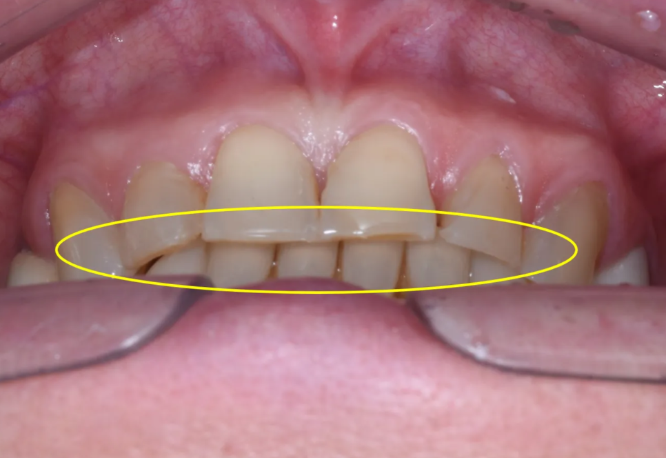 강남구청역 치과, 70대 외국인 환자의 라미네이트 관련 이미지 3