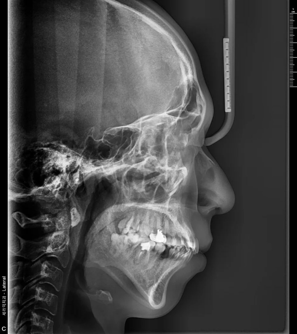 돌출입 교정 전후, 그런데 과개교합까지 있으셨던 환자분 관련 이미지 7