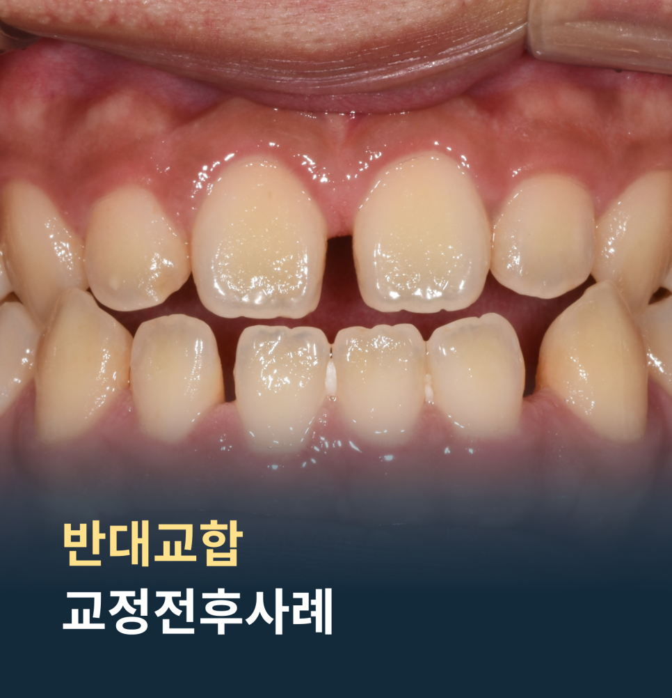 치아가 반대로 물리는 관련 이미지 1