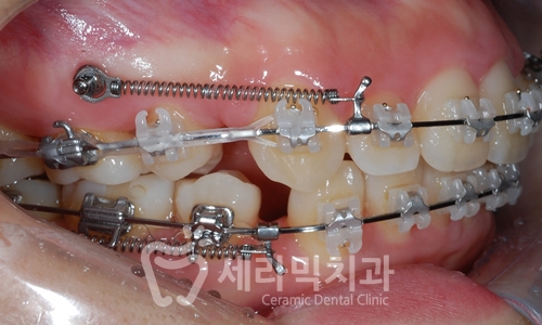 치아교정만으로 세마리 토끼를 한번에! 돌출입, 무턱, 치열불규칙 치아교정전후 관련 이미지 8