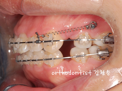 강남 돌출 관련 이미지 26