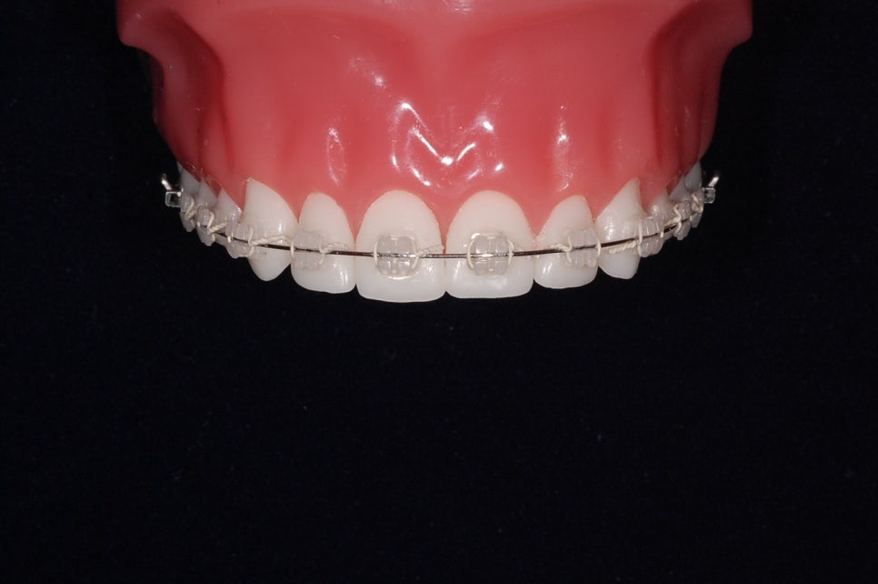 세라믹치과 치아교정일기 - 김여정 관련 이미지 1