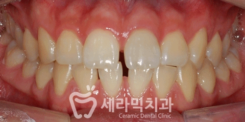 벌어진치아, 앞니벌어짐 치아교정전후 관련 이미지 2
