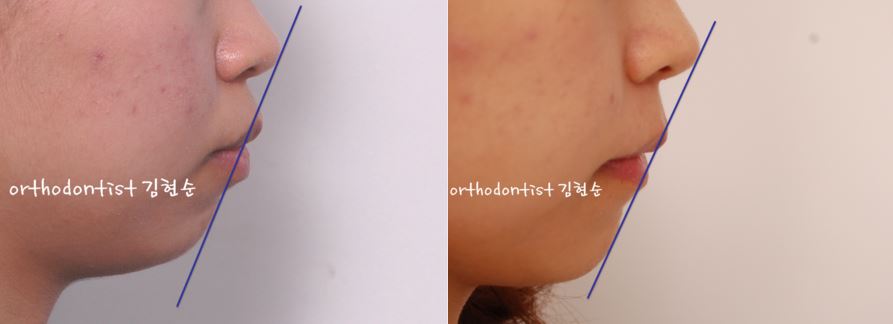 세라믹치과 "돌출입 발치교정" 관련 이미지 11