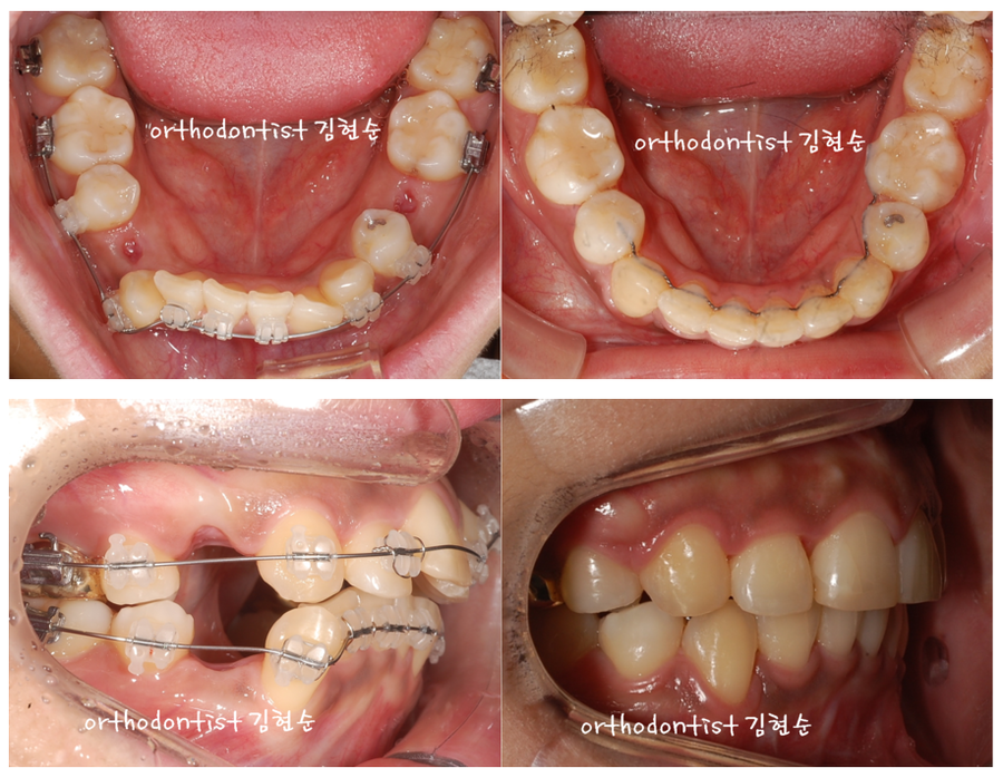 발치 교정으로 덧니 치열 올바로 잡기 관련 이미지 7