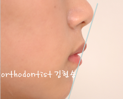 강남 덧니 관련 이미지 31