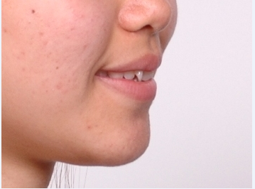 강남 돌출입 교정 관련 이미지 3