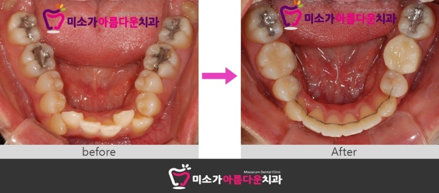 세라믹교정 덧니교정 세라믹치과에서 ~~ 관련 이미지 6