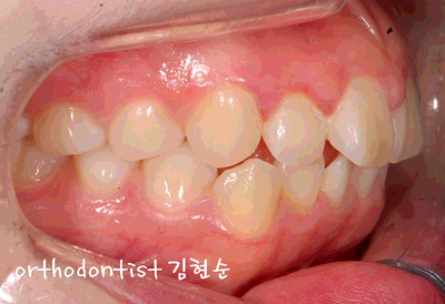 강남 돌출 관련 이미지 11