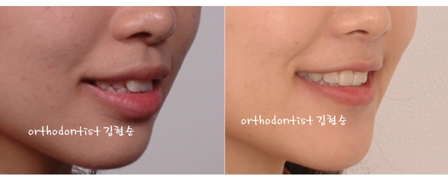 세라믹교정 은 세라믹치과 수술없이 돌출개선 관련 이미지 10