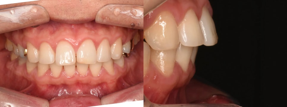 돌출입 재교정, 그것도 세 번째. 관련 이미지 2