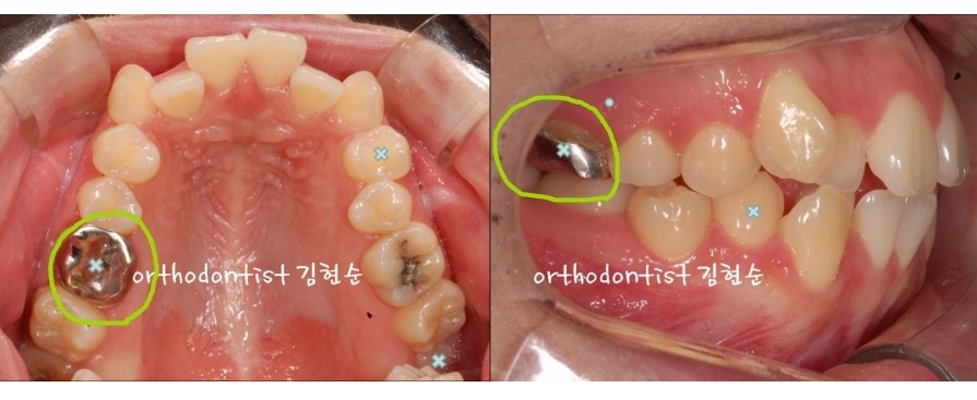 세라믹교정 은 관련 이미지 3