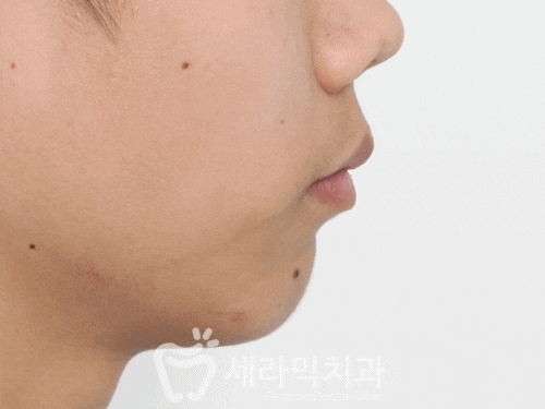 딥바이트 과개교합 치아교정전후 활짝 웃게 된 사례 관련 이미지 3
