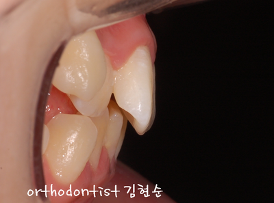 강남 돌출 (토끼 치아) 관련 이미지 6