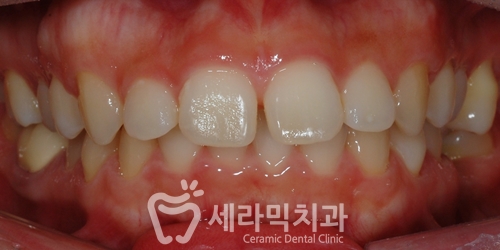 벌어진 돌출입 치아교정으로 빈틈없이 깔끔하게! 관련 이미지 1