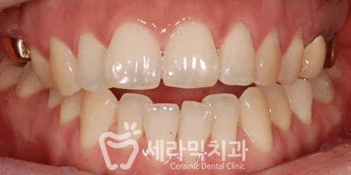 상실된 치아가 있어도, 금니가 있어도 치아교정전후는 계속된다! 관련 이미지 4