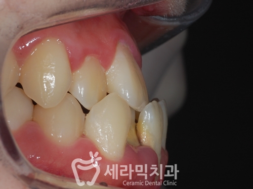반대교합과 돌출입 고민, 세라믹교정으로 해결 완료! 관련 이미지 1