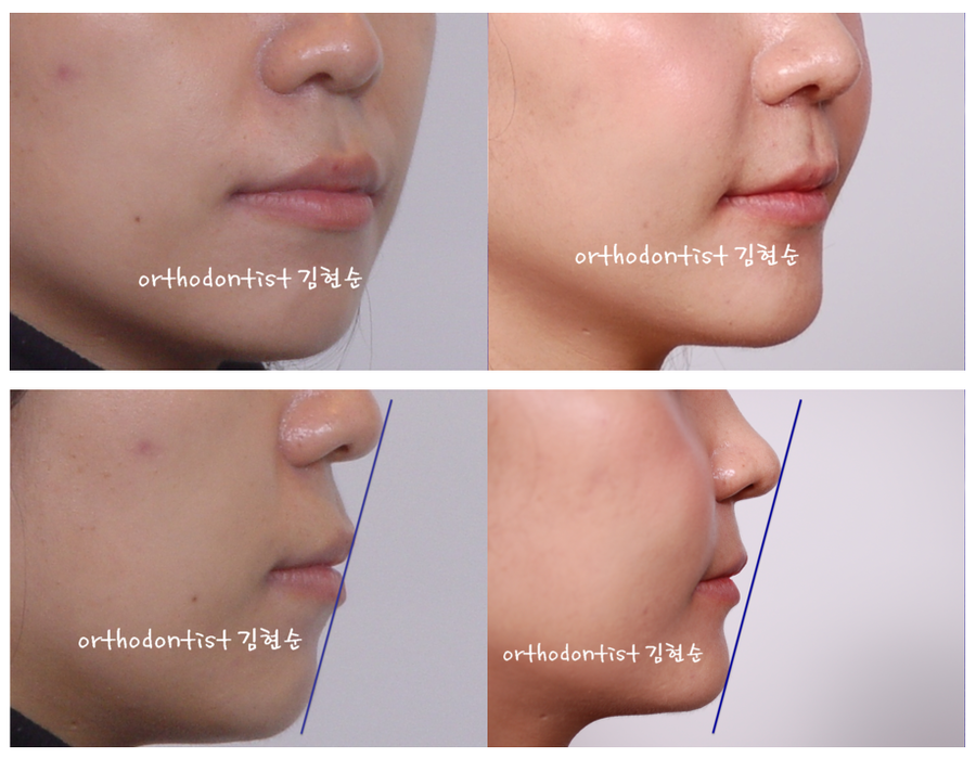 돌출입발치 교정증례 관련 이미지 8