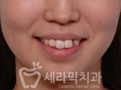 치아교정 전후 확연한 인상 변화! 관련 이미지 4