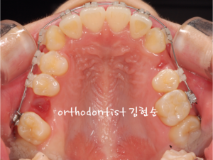 세라믹교정 은 관련 이미지 5