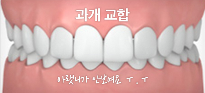 과개교합 무턱 개선 관련 이미지 3