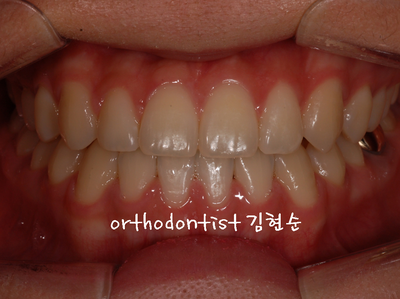 반대 교합 관련 이미지 25