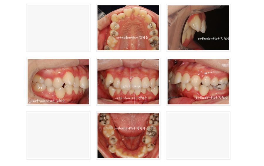 돌출입 발치교정, 미니스크류를 통한 6가지 변화 관련 이미지 7