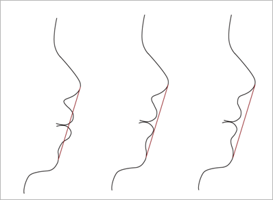 학동역치과 돌출입교정은 세라믹치과에서 관련 이미지 3