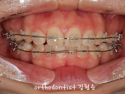 강남 돌출 관련 이미지 20