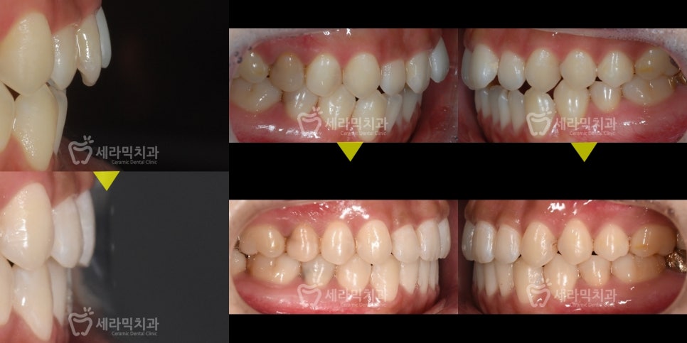 Open Bite Dental Clinic Orthodontic Before and After: Did a Long-Looking Jaw Become Shorter? image 10