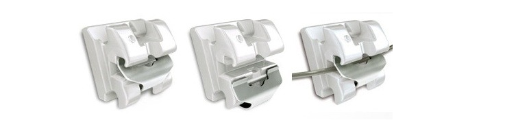 강남 교정치과 클리피씨 교정이 비싼 이유 관련 이미지 3