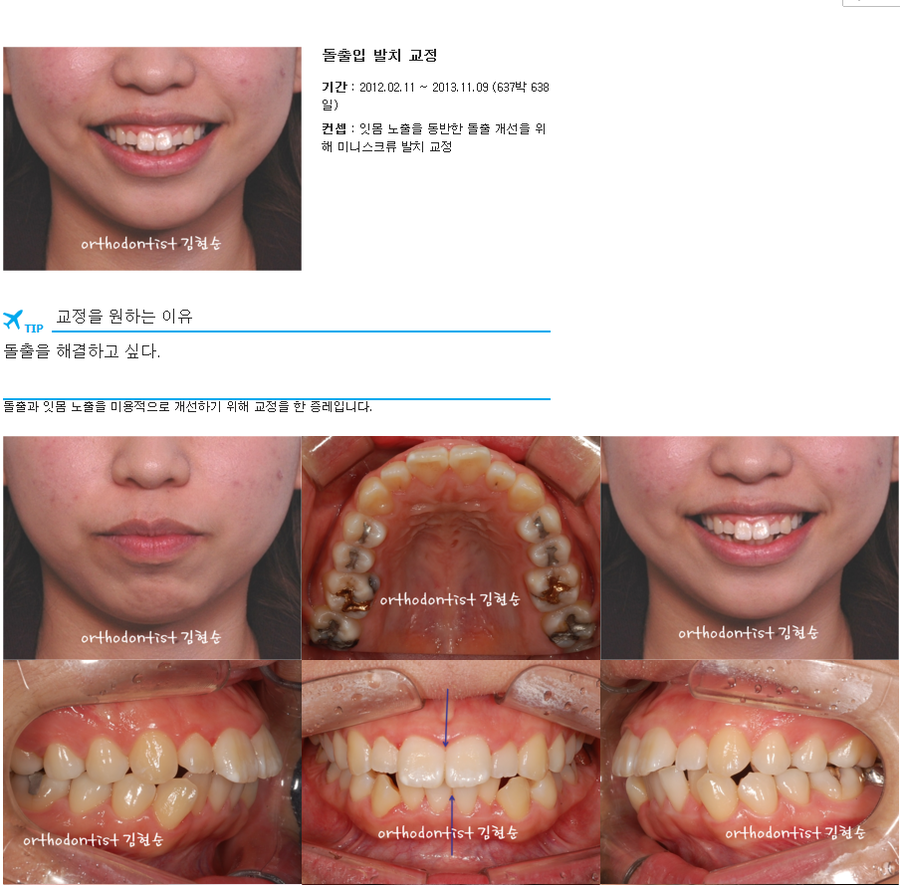 세라믹교정 세라믹치과-돌출입발치교정 5 관련 이미지 1