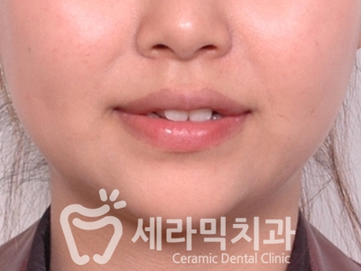 토끼이빨, 틀어진 치아배열 세라믹교정 전후사진 관련 이미지 3