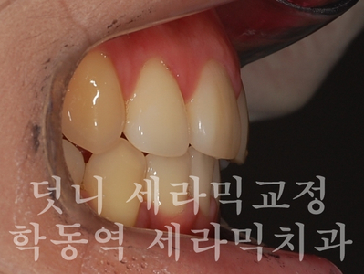 덧니교정 잘하는 학동역 교정치과, 세라믹치과 관련 이미지 9