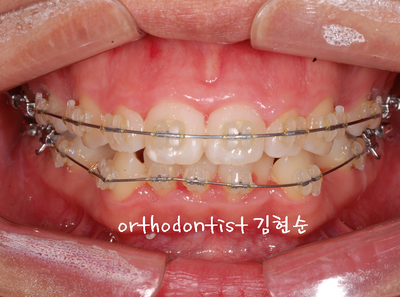 강남 돌출 관련 이미지 18