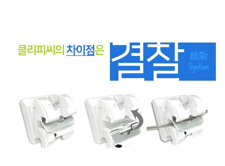 세라믹교정과 클리피씨중 선택은 ? 내 맘대로? 관련 이미지 9
