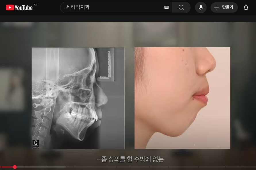 학동역치과 성인 돌출입교정, 비수술 · 비발치 고민하고 있다면 관련 이미지 4