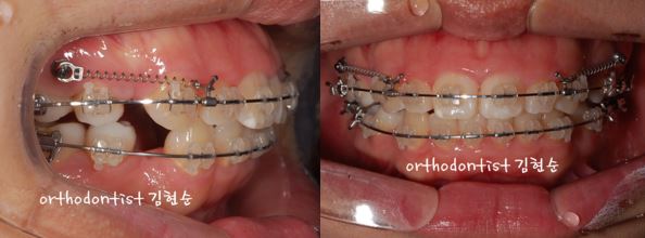 세라믹치과 "돌출입 발치교정" 관련 이미지 7