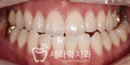 반대교합과 아래 돌출입 치아교정전후 관련 이미지 4