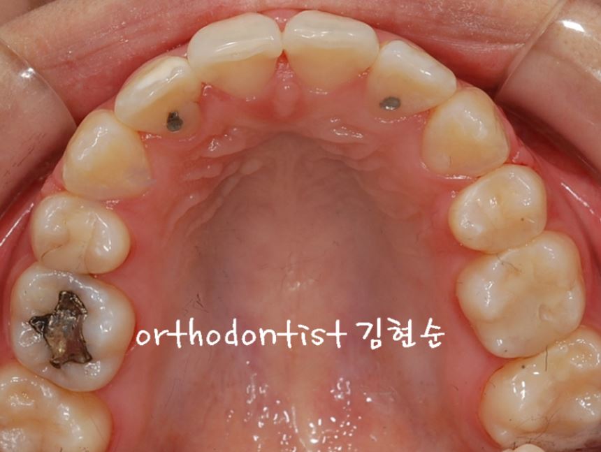 세라믹치과 수술없이 돌줄입교정 관련 이미지 8