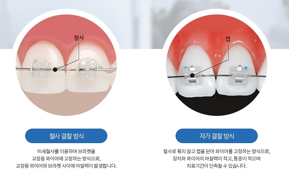 How to Choose an Orthodontic Appliance Without Regret image 6